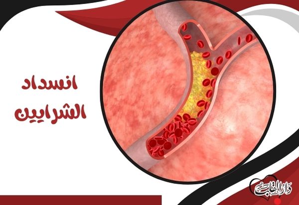 انسداد الشرايين
