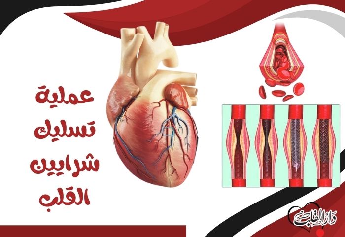 عملية توسيع شرايين القلب