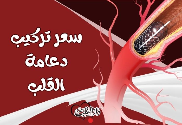 سعر تركيب دعامة القلب