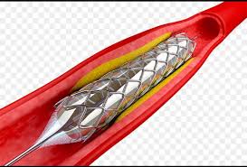 توسيع شرايين القلب بالبالون