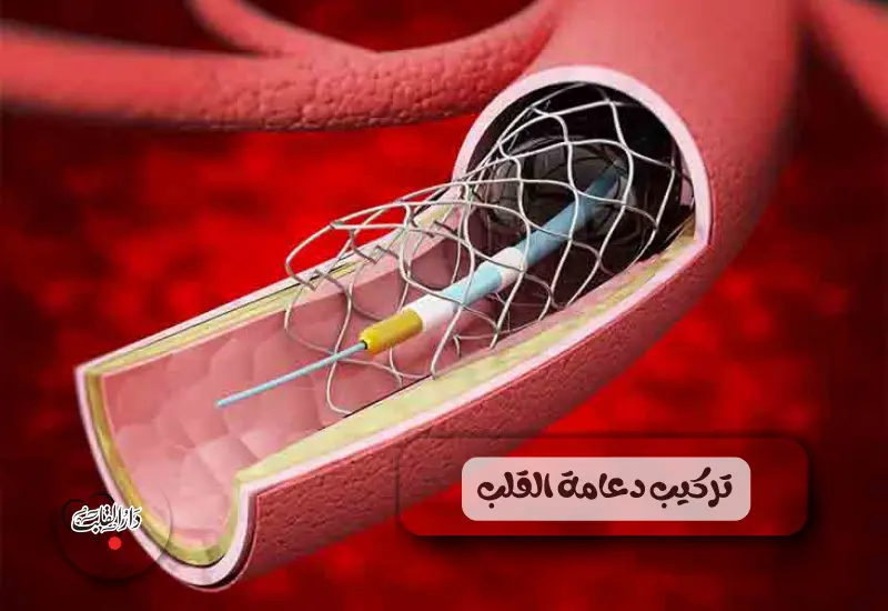 تركيب دعامة القلب