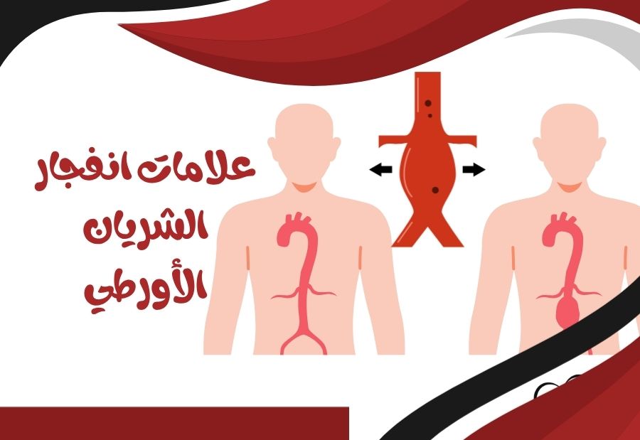 علامات انفجار الشريان الأورطي