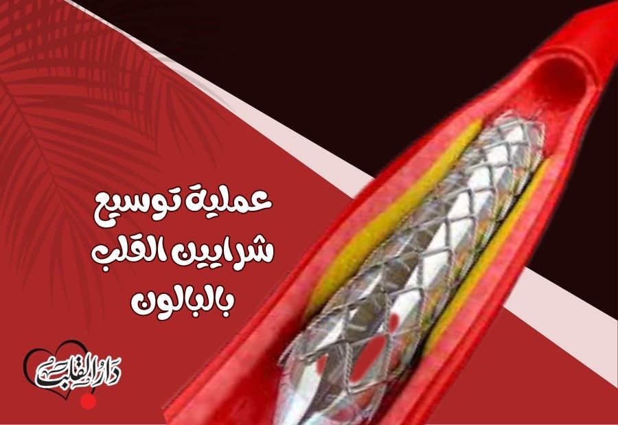 عملية-توسيع-شرايين-القلب-بالبالون.jpg