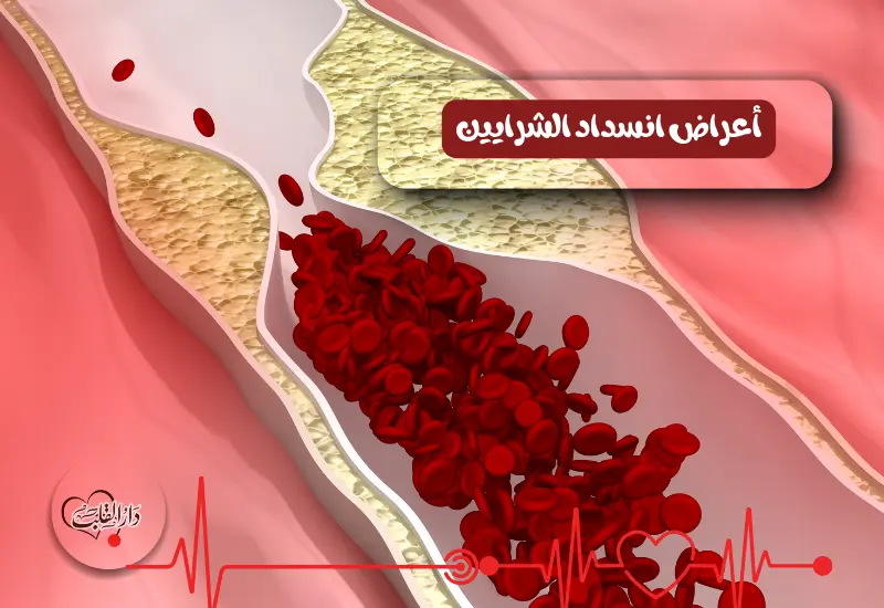 أعراض انسداد الشرايين