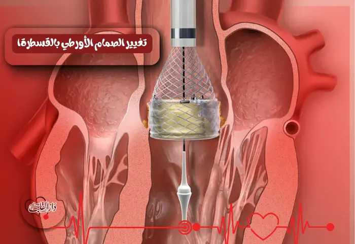 _تغيير الصمام الأورطي بالقسطرة في طنطا