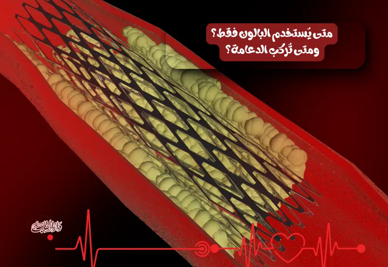 متى يُستخدم البالون فقط؟ ومتى تُركب الدعامة؟