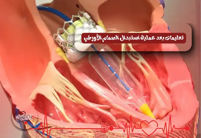 تعليمات بعد عملية استبدال الصمام الأورطي