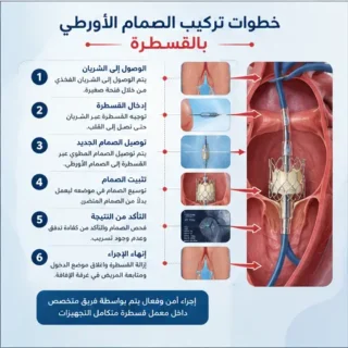 خطوات_تركيب_الصمام_الأورطي_بالقسطرة
